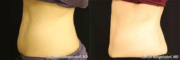 CoolSculpting Before & After Image