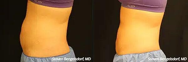 CoolSculpting Before & After Image