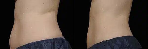 CoolSculpting Before & After Image
