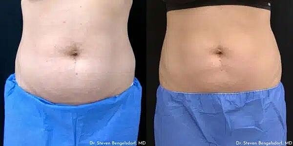 CoolSculpting Before & After Image
