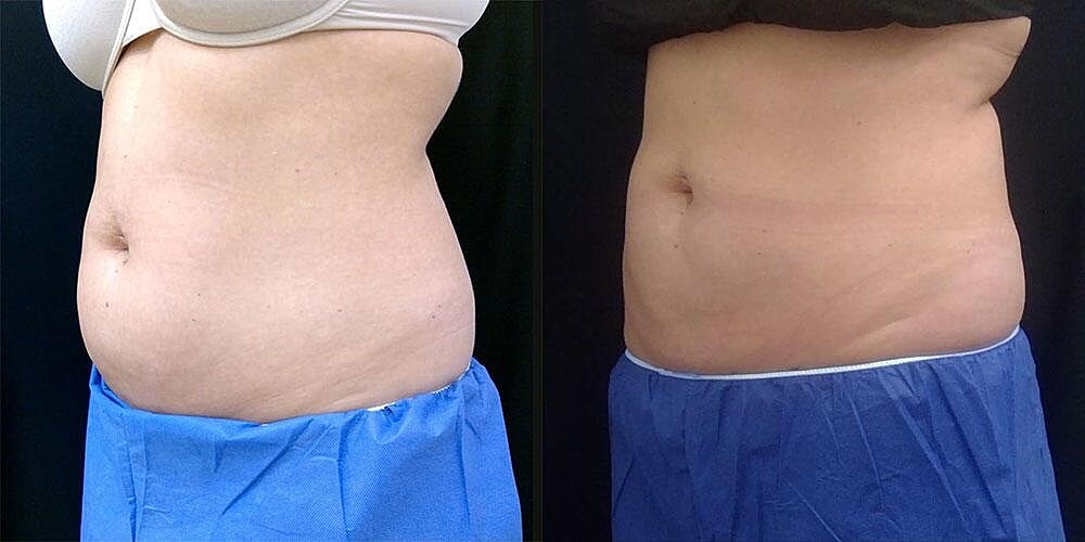 CoolSculpting Before & After Image