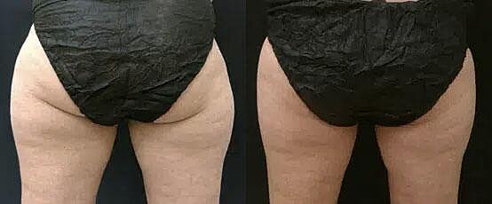 CoolSculpting Before & After Image