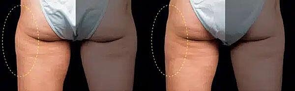 CoolSculpting Before & After Image