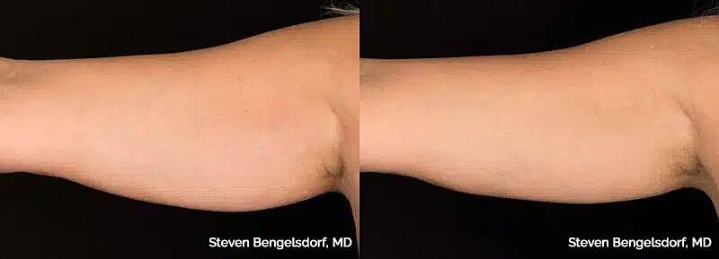 CoolSculpting Before & After Image
