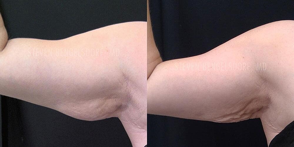 CoolSculpting Before & After Image