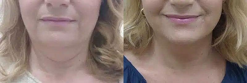 CoolSculpting Before & After Image