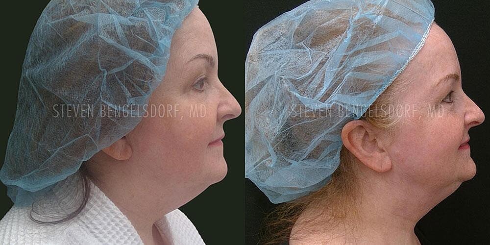 CoolSculpting Before & After Image