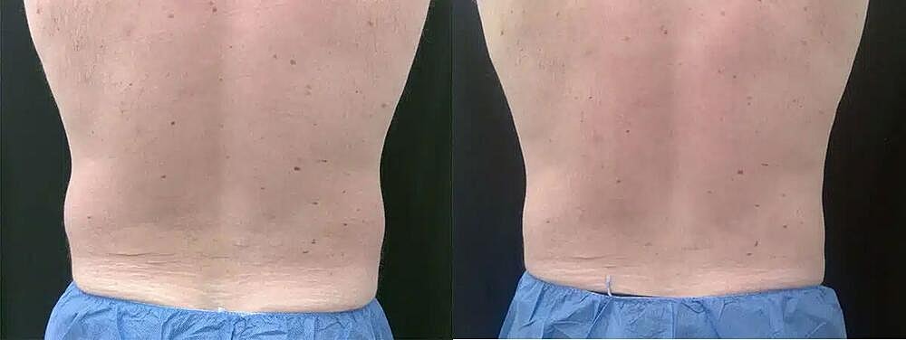 CoolSculpting Before & After Image