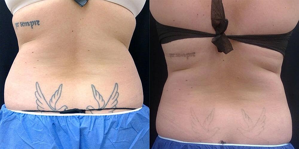 CoolSculpting Before & After Image