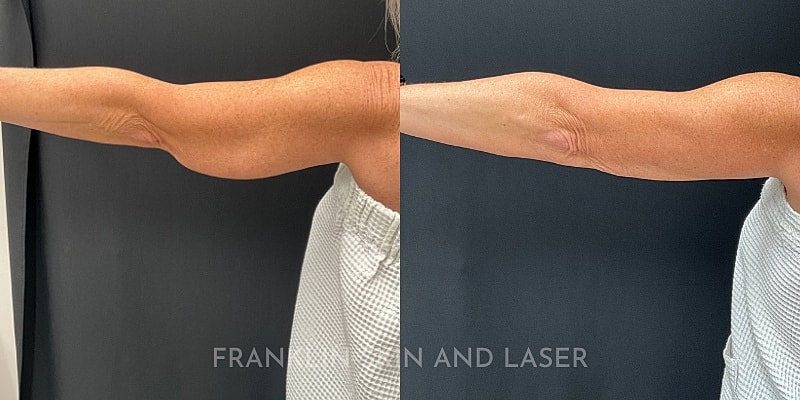 CoolSculpting Before & After Image