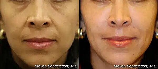 Undereye Fillers Before & After Image