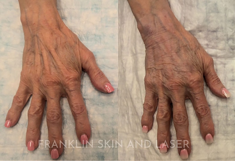 Hand Filler Before & After Image