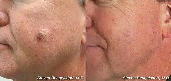 Mole Removal Before & After Image