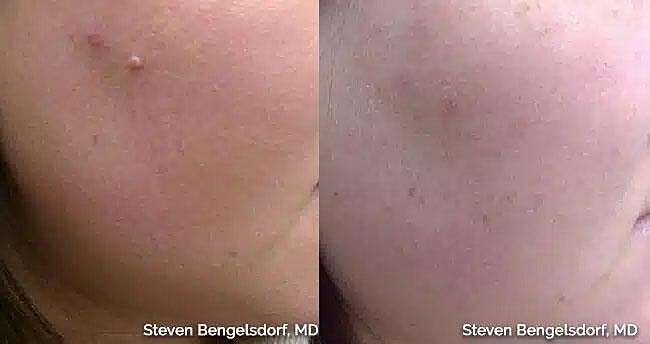 Mole Removal Before & After Image