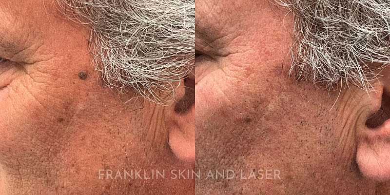 Mole Removal Before & After