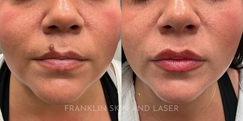 Mole Removal Gallery Before & After