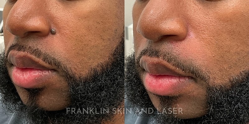 Mole Removal Gallery Before & After