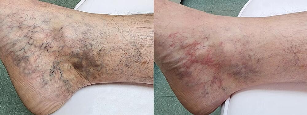 Laser Vein Reduction Before & After Image