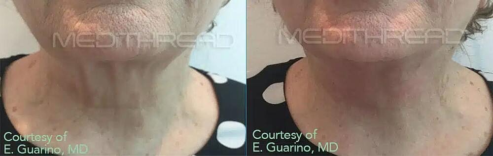Thread Lift Before & After Image