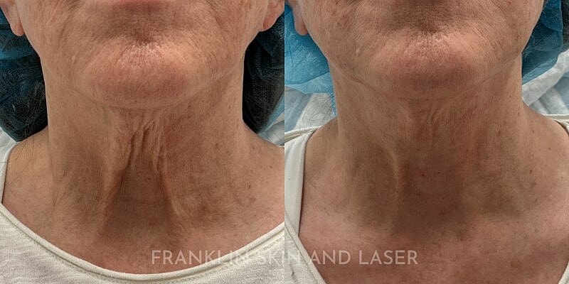 Thread Lift Before & After Image