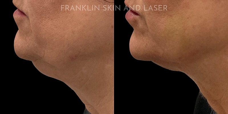Thread Lift Before & After Image