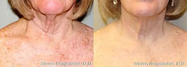 Photorejuvenation Before & After