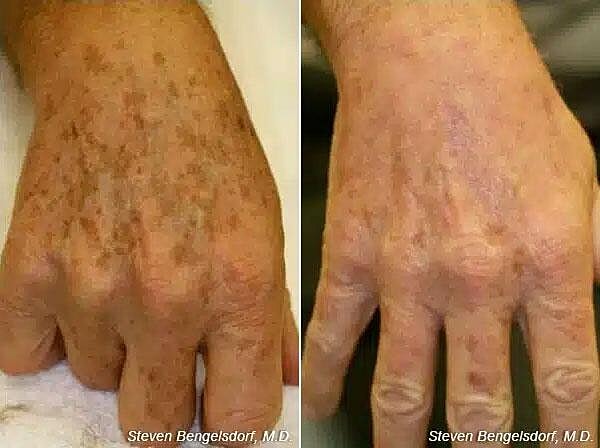Photorejuvenation Before & After