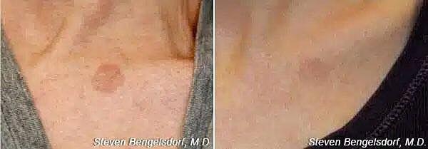 Photorejuvenation Before & After