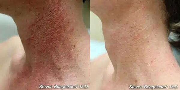 Photorejuvenation Before & After