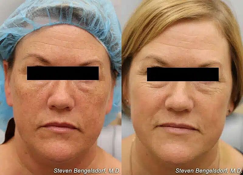 Photorejuvenation Before & After