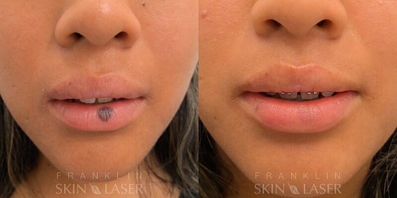 Photorejuvenation Before & After