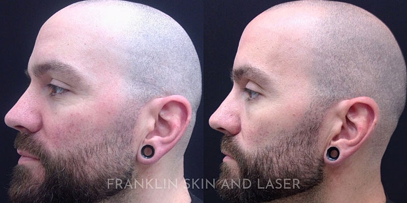 Photorejuvenation Before & After