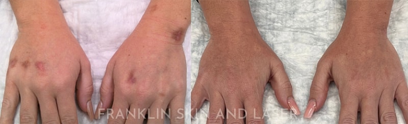 Photorejuvenation Before & After