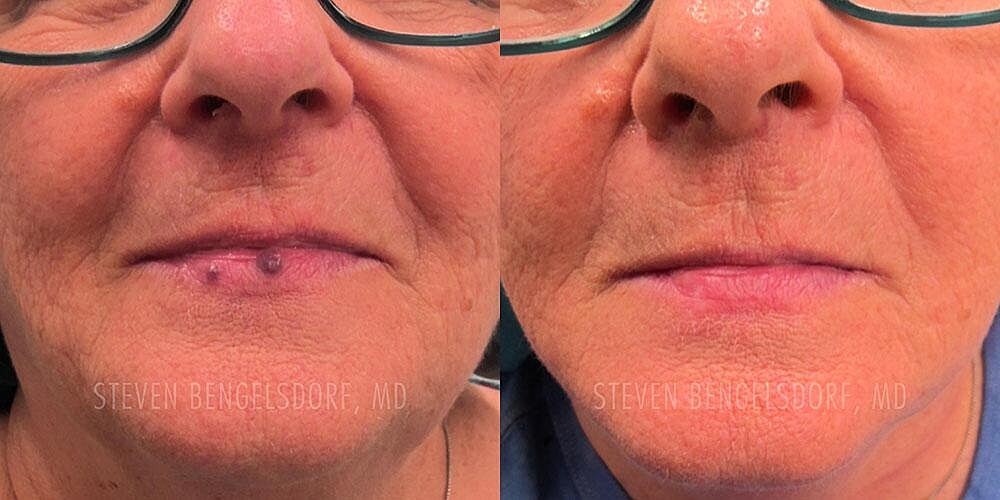 Venous Lake Removal Before & After Image