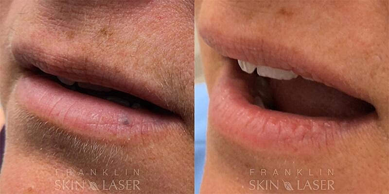Venous Lake Removal Before & After Image