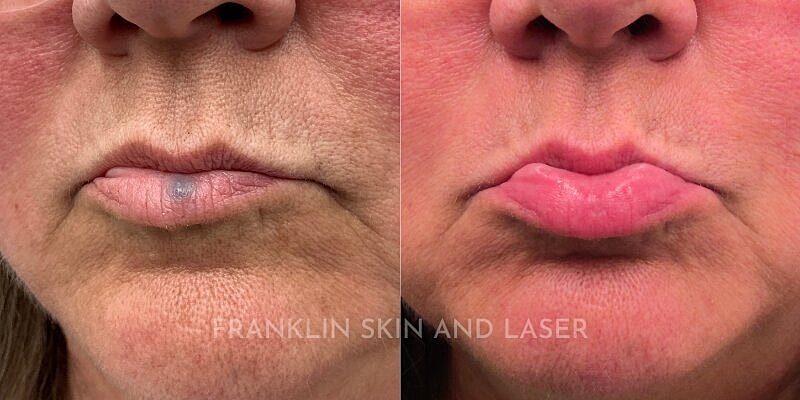 Venous Lake Removal Before & After Image
