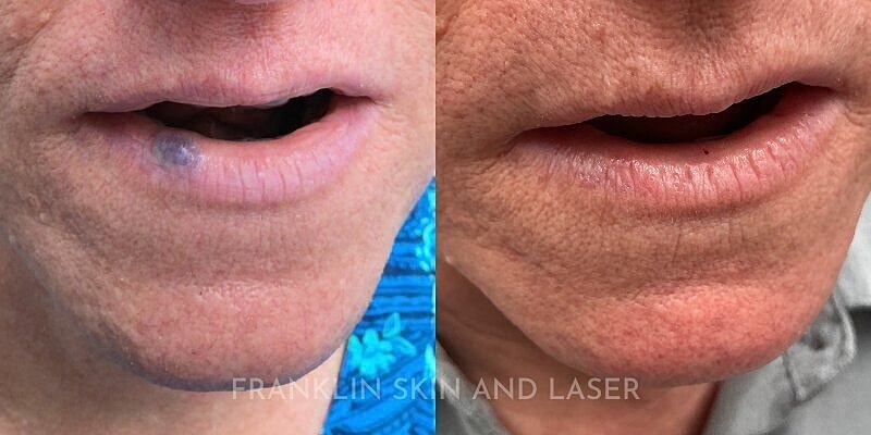 Venous Lake Removal Before & After Image