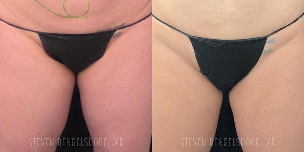 Emsculpt NEO Before & After Image