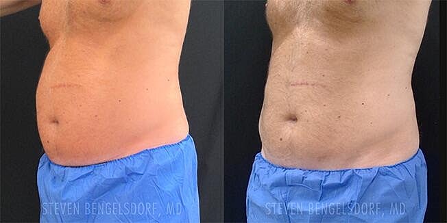 Emsculpt NEO Before & After Image