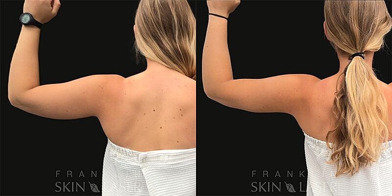Emsculpt NEO Before & After Image