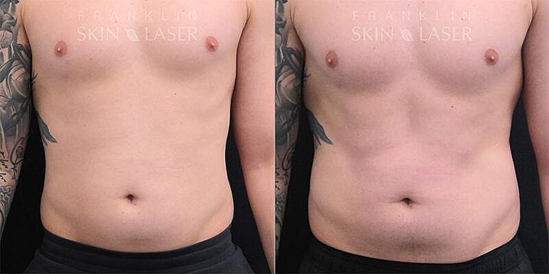 Emsculpt NEO Before & After Image