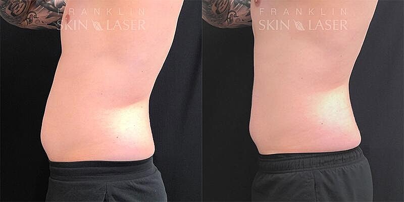Emsculpt NEO Before & After Image