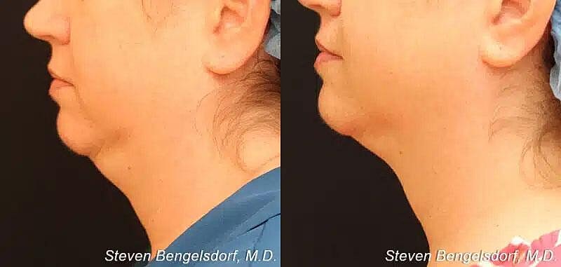Kybella Before & After