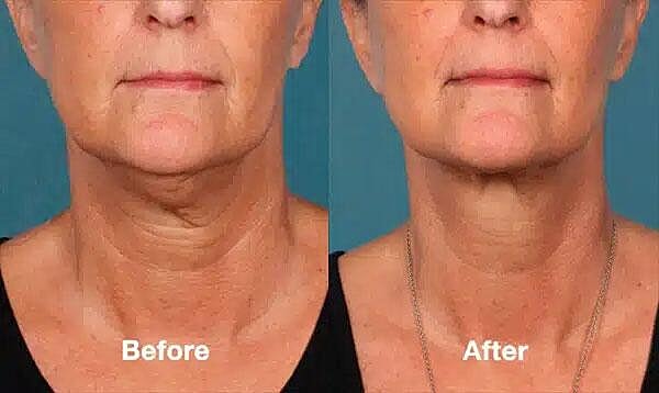 Kybella Before & After
