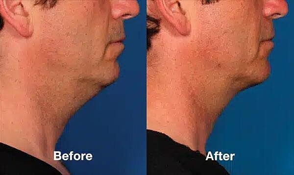 Kybella Before & After