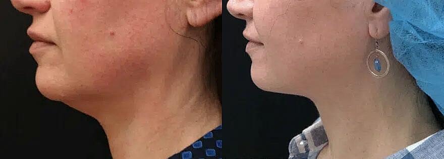 Kybella Before & After
