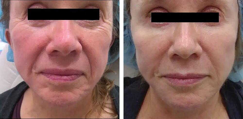 Mid Face Filler Before & After