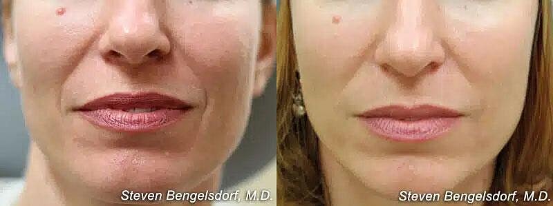 Mid Face Filler Before & After