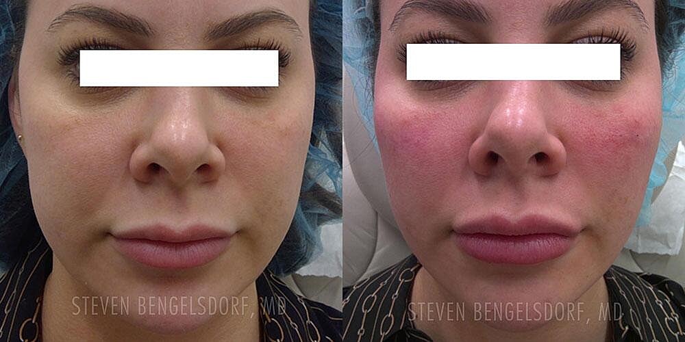 Mid Face Filler Before & After