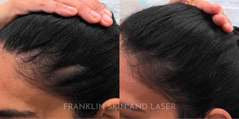 Hair Restoration Before & After Image